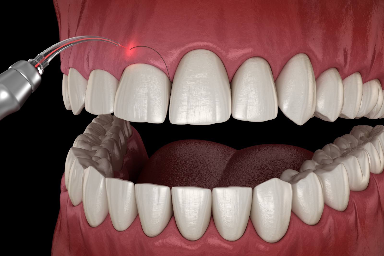 3D model of gingivectomy procedure