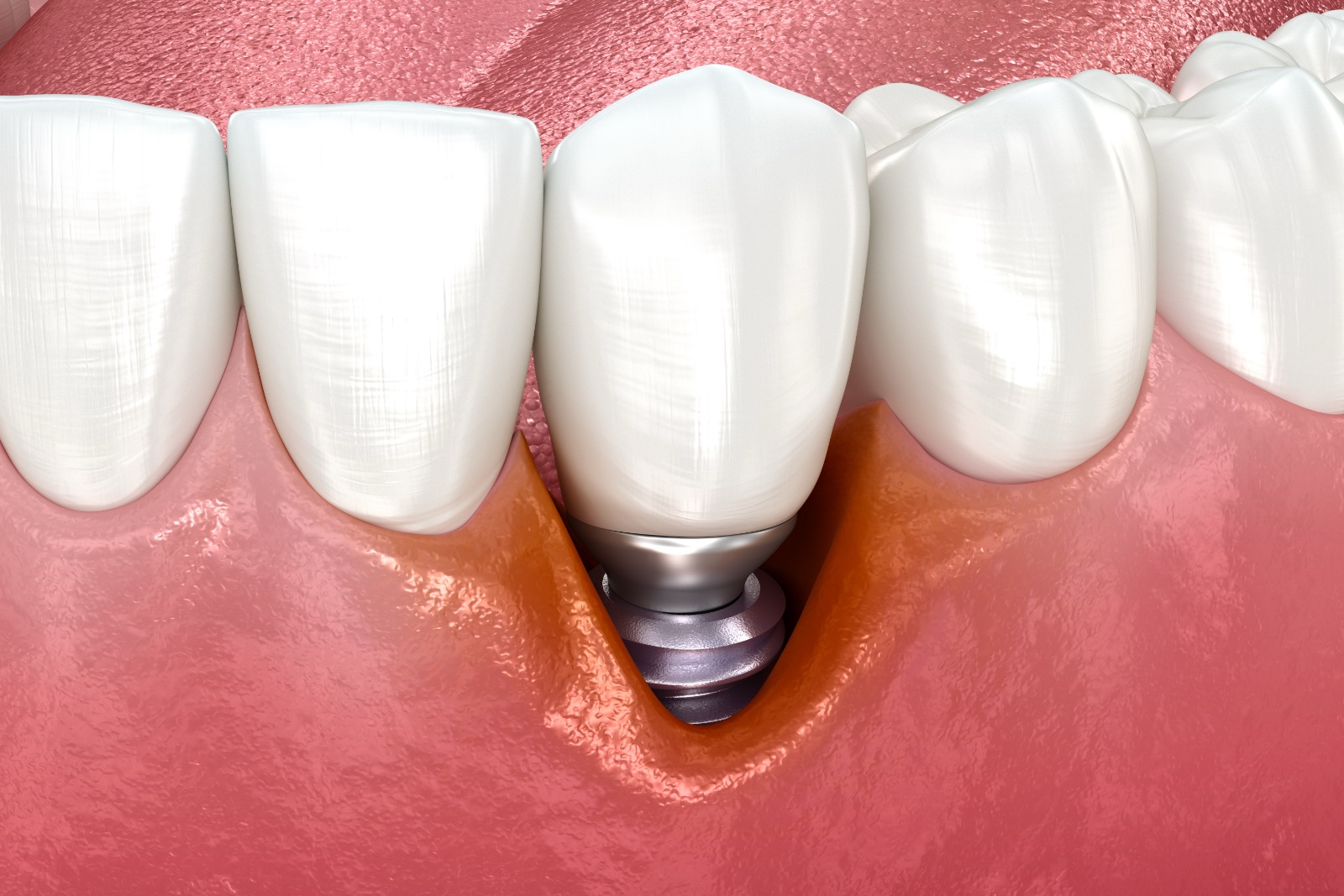 Peri-implantitis with visible gingiva recession. Medically accurate 3D illustration.