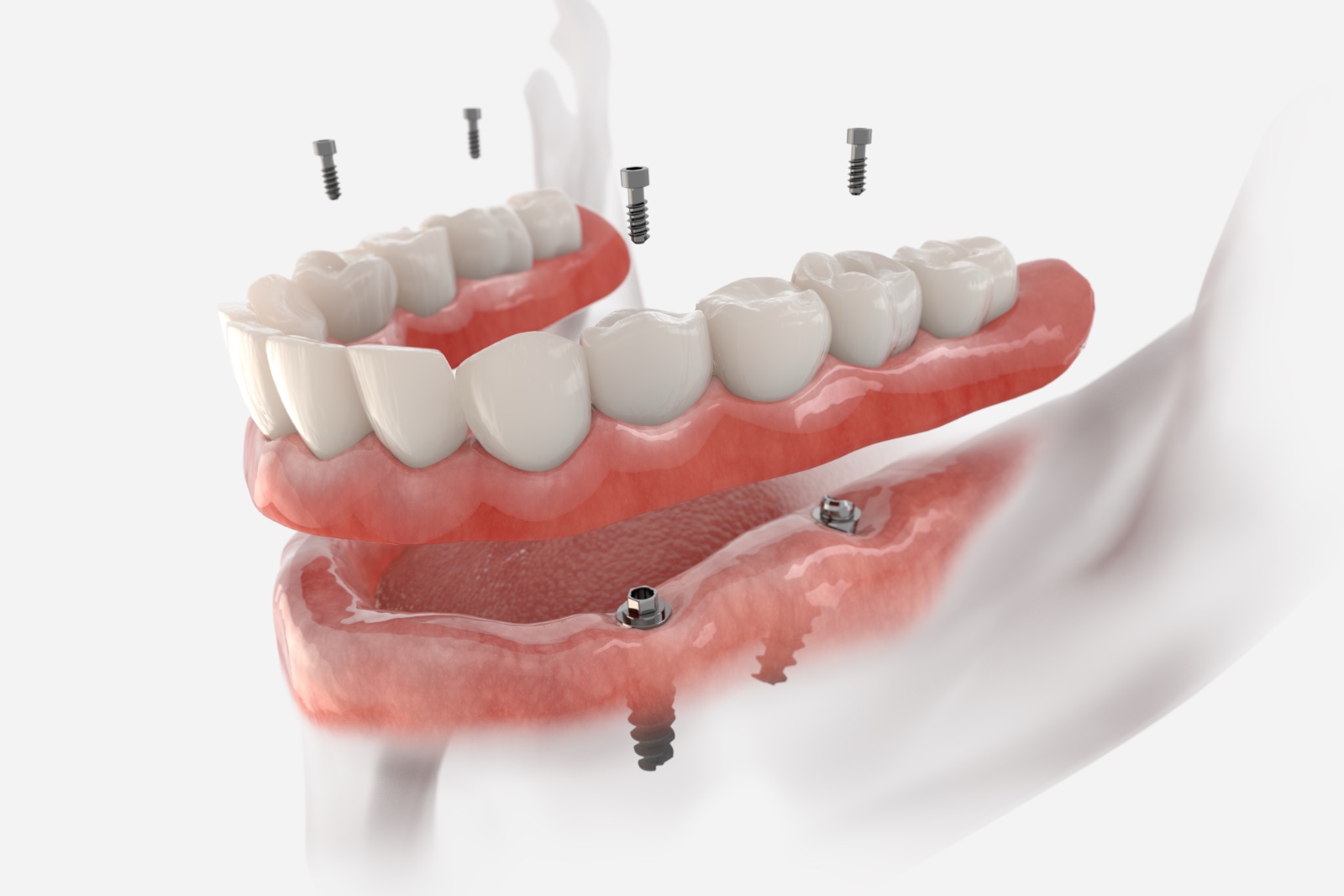 New Teeth in One Day diagram